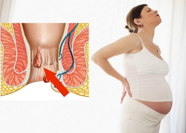 Геморрой при беременности: как избежать проблем и что делать, если они все же возникли - фото2