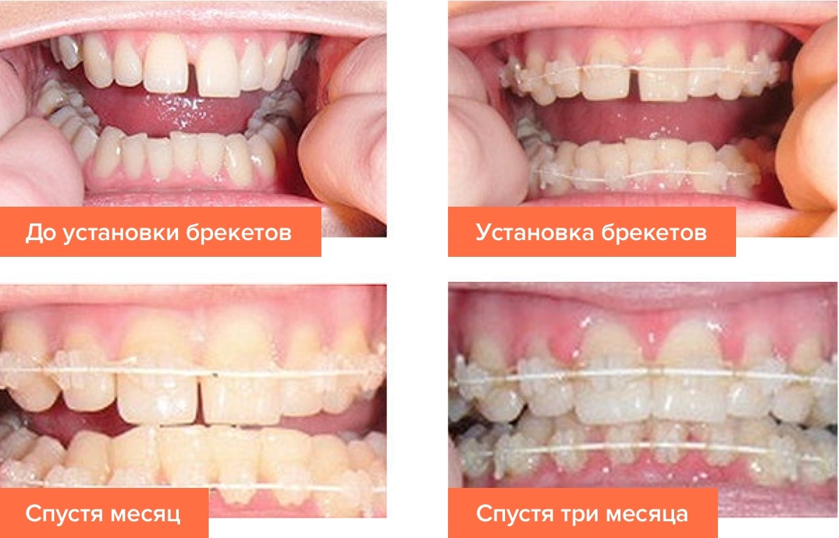 Сапфировые брекеты для зубов: преимущества, обзор, фото до и после лечения - 4 Сапфировые брекеты для зубов: преимущества, обзор, фото до и после лечения - 4