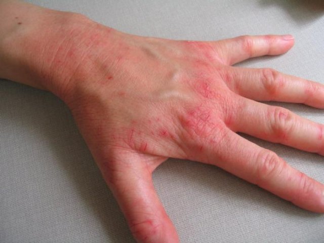 Дерматологические заболевания кожи: фото, обзор