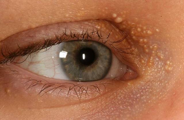 Как избавиться от Milia (милиа): причины, лечение, профилактика - фото2