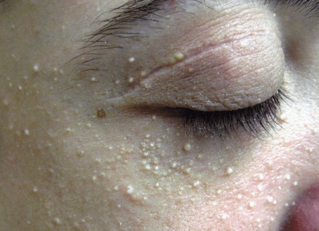 Как избавиться от Milia (милиа): причины, лечение, профилактика - фото3