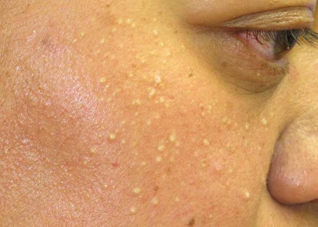 Как избавиться от Milia (милиа): причины, лечение, профилактика - фото4