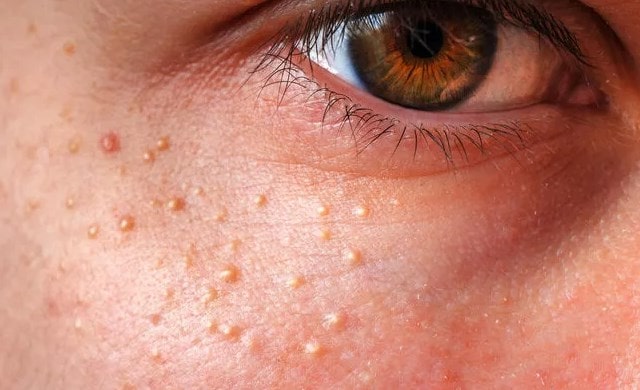 Как избавиться от Milia (милиа): причины, лечение, профилактика - фото5