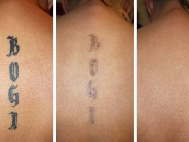 Руководство по удалению татуировок: способы, советы дерматологов - фото1 Руководство по удалению татуировок: способы, советы дерматологов - фото1