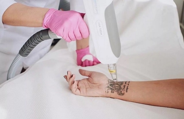 Руководство по удалению татуировок: способы, советы дерматологов - фото2 Руководство по удалению татуировок: способы, советы дерматологов - фото2