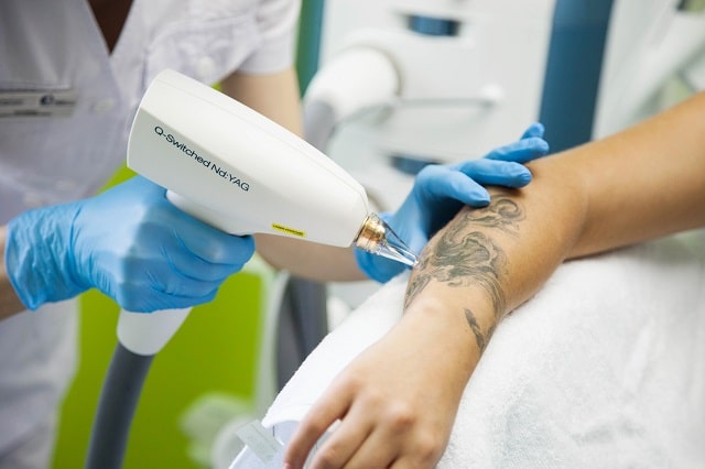 Руководство по удалению татуировок: способы, советы дерматологов - фото5 Руководство по удалению татуировок: способы, советы дерматологов - фото5