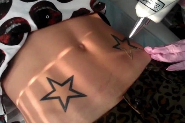 Руководство по удалению татуировок: способы, советы дерматологов - фото6 Руководство по удалению татуировок: способы, советы дерматологов - фото6