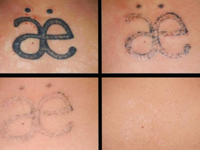 Руководство по удалению татуировок: способы, советы дерматологов - фото8 Руководство по удалению татуировок: способы, советы дерматологов - фото8