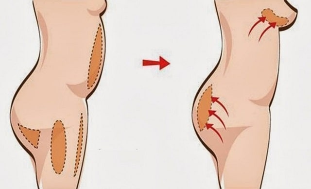 Липофилинг: что это такое и для чего нужно - фото1