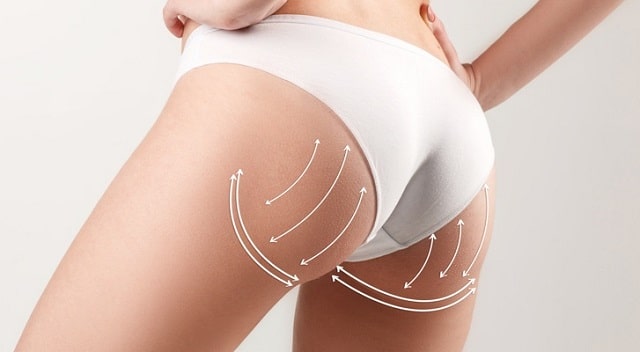 Липофилинг: что это такое и для чего нужно - фото2