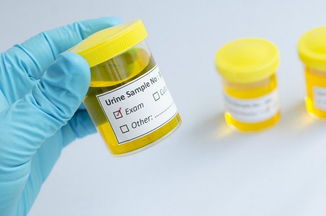 Анализ мочи: виды, что показывает, как правильно сдавать взрослому - фото1 Анализ мочи: виды, что показывает, как правильно сдавать взрослому - фото1