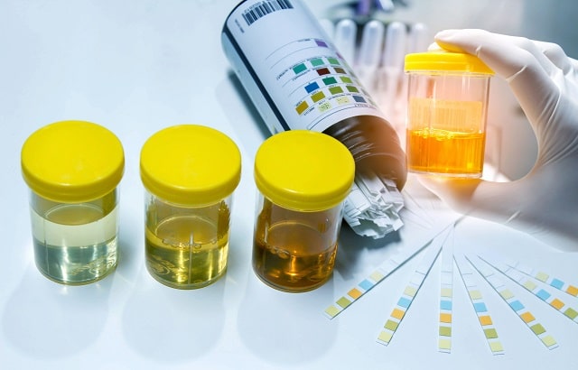 Анализ мочи: виды, что показывает, как правильно сдавать взрослому - фото2 Анализ мочи: виды, что показывает, как правильно сдавать взрослому - фото2