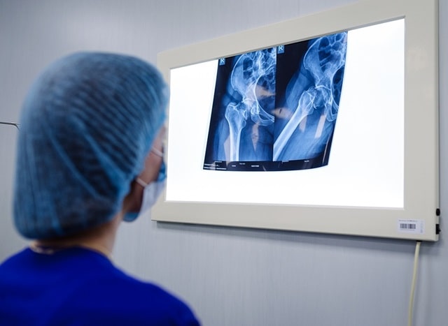 Артроз колінного суглоба: діагностика та сучасні напрями лікування - фото2 Артроз колінного суглоба: діагностика та сучасні напрями лікування - фото2