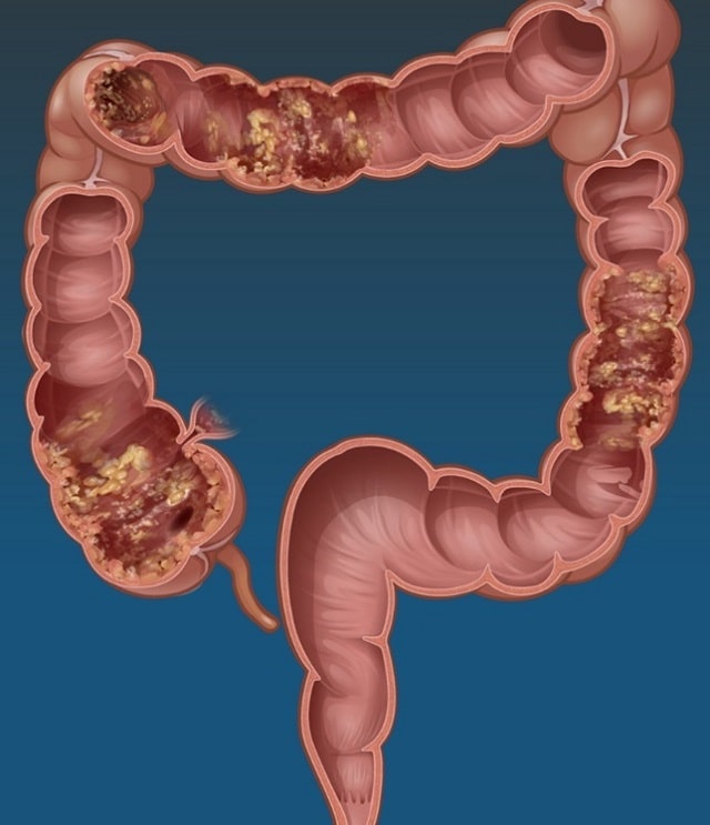 Болезнь Крона: что это такое, симптомы, профилактика - фото1