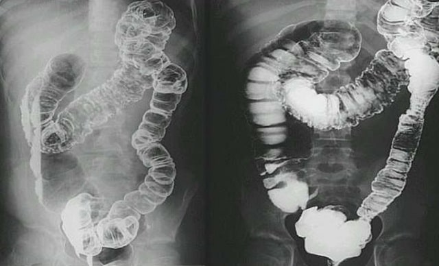 Болезнь Крона: что это такое, симптомы, профилактика - фото2