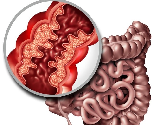 Болезнь Крона: что это такое, симптомы, профилактика - фото3