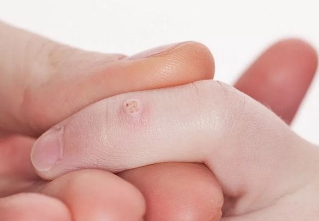 Бородавки: что это такое, причины, профилактика - фото1 Бородавки: что это такое, причины, профилактика - фото1