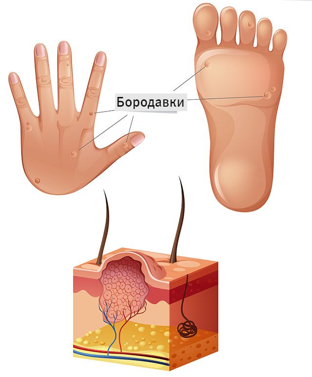 Бородавки: что это такое, причины, профилактика - фото2 Бородавки: что это такое, причины, профилактика - фото2