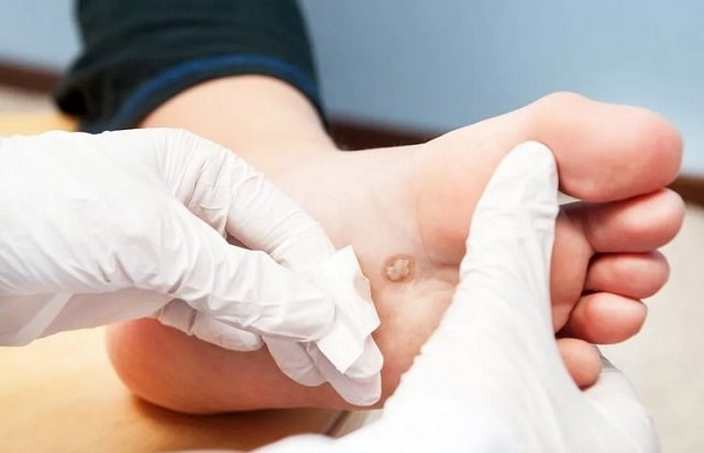 Бородавки: что это такое, причины, профилактика - фото3 Бородавки: что это такое, причины, профилактика - фото3