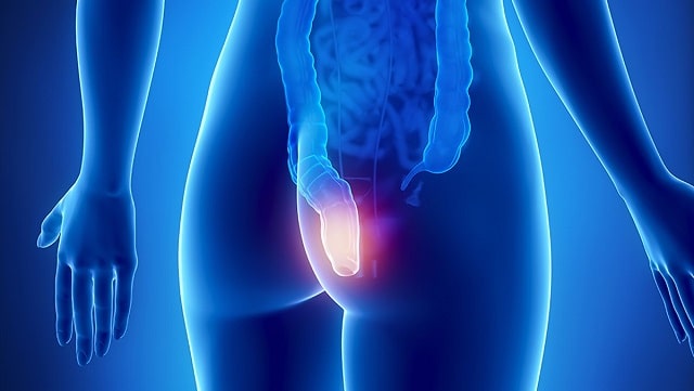 Геморрой: что это за заболевание, причины, симптомы, профилактика - фото2 Геморрой: что это за заболевание, причины, симптомы, профилактика - фото2