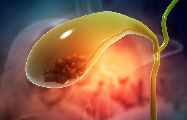 Гепатобилиарная система (ГБС): что это такое, распространенные заболевания и их особенности - Желчнокаменная болезнь
