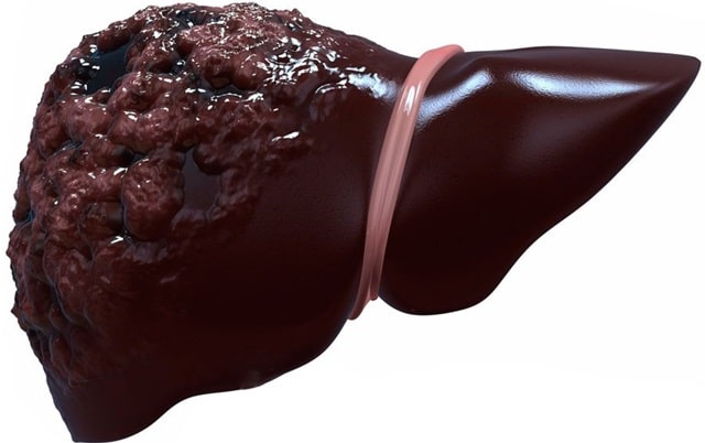 Гепатобилиарная система (ГБС): что это такое, распространенные заболевания и их особенности - Цирроз печени