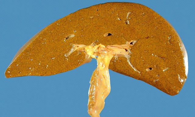 Гепатобилиарная система (ГБС): что это такое, распространенные заболевания и их особенности - Холестаз