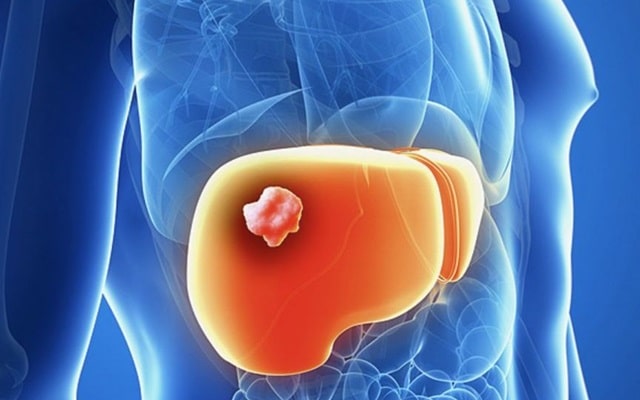 Гепатобилиарная система (ГБС): что это такое, распространенные заболевания и их особенности - Рак печени