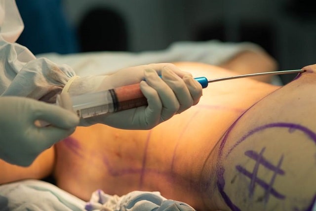 Липосакция: что это такое, виды, как проходит - фото3