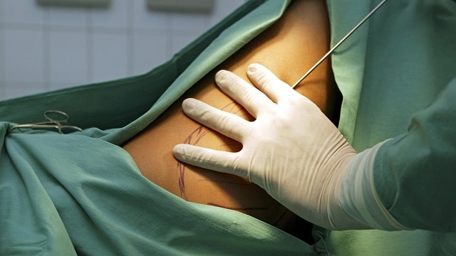 Липосакция: что это такое, виды, как проходит - фото4