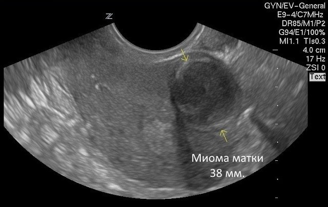 Миома матки: что это такое, виды, симптомы и причины - фото2 Миома матки: что это такое, виды, симптомы и причины - фото2