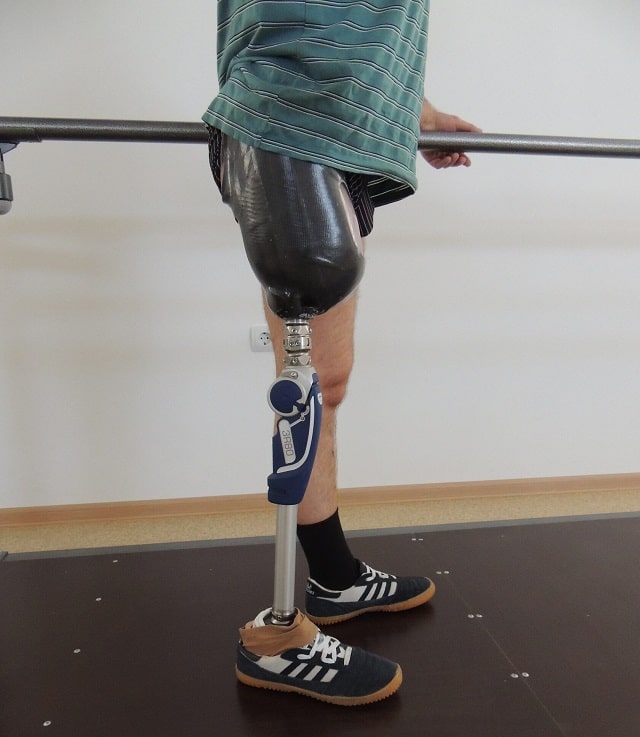 Модульний протез стегна: що це таке, види та можливості - фото1