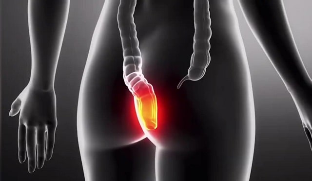 Основні симптоми геморою: як вчасно визначити хворобу - фото2