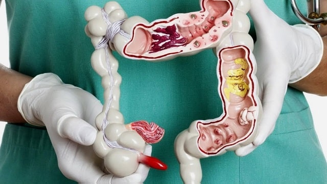 Основні симптоми геморою: як вчасно визначити хворобу - фото3
