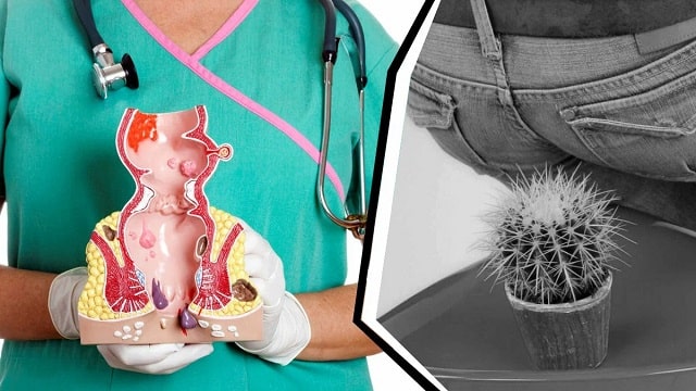 Основні симптоми геморою: як вчасно визначити хворобу - фото4