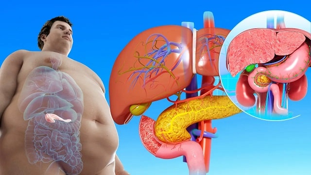 Панкреатит: что это за болезнь, причины, профилактика - фото2