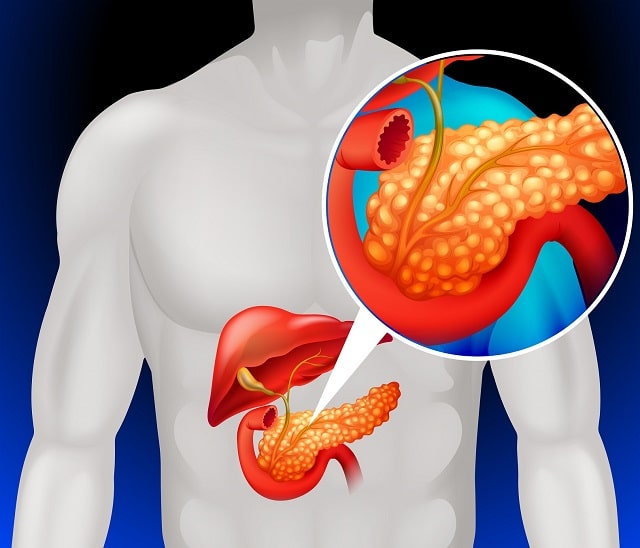 Панкреатит: что это за болезнь, причины, профилактика - фото4