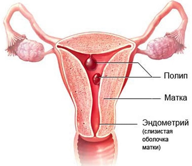 Полипы эндометрия: что это такое, причины, профилактика - фото4