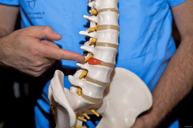 Протрузия дисков позвоночника: что это такое, симптомы, профилактика - фото1 Протрузия дисков позвоночника: что это такое, симптомы, профилактика - фото1