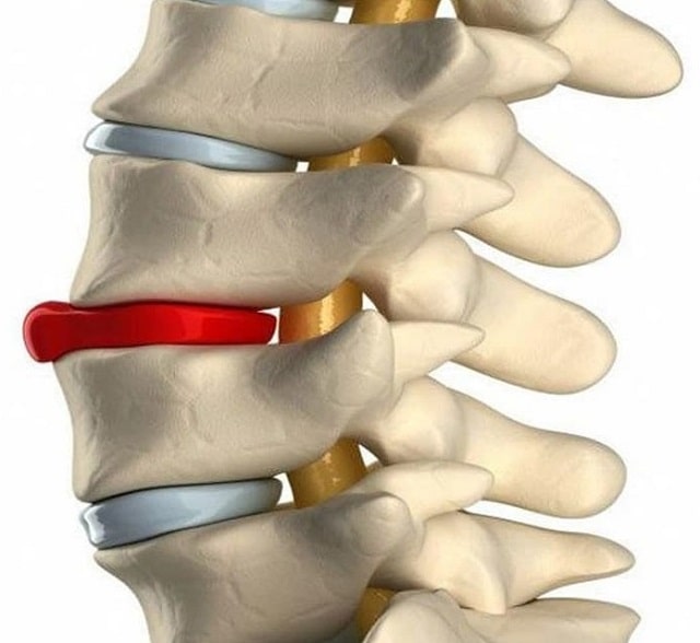 Протрузия дисков позвоночника: что это такое, симптомы, профилактика - фото2 Протрузия дисков позвоночника: что это такое, симптомы, профилактика - фото2