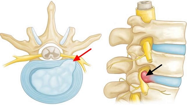 Протрузия дисков позвоночника: что это такое, симптомы, профилактика - фото4 Протрузия дисков позвоночника: что это такое, симптомы, профилактика - фото4