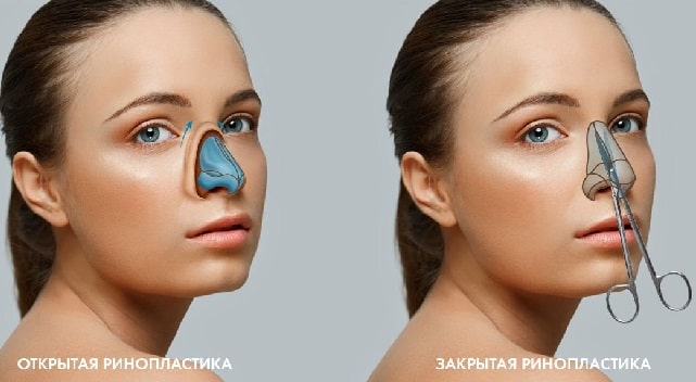 Ринопластика: что это такое и как проходит - фото2 Ринопластика: что это такое и как проходит - фото2