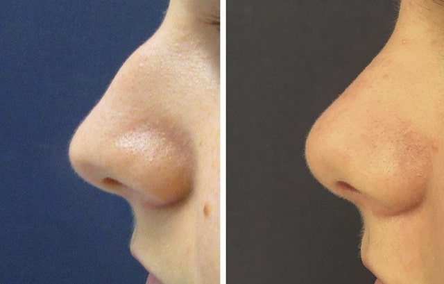 Ринопластика: что это такое и как проходит - фото5 Ринопластика: что это такое и как проходит - фото5