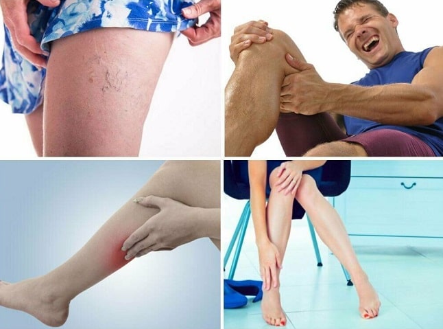 Варикоз: что это такое (симптомы, причины, профилактика) - фото2