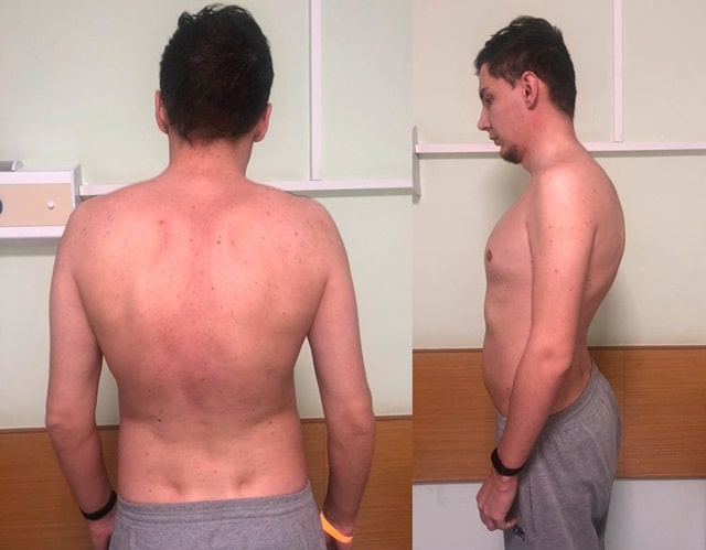 Юнацький кіфоз Шейермана: що це таке, чому виникає, чим небезпечний - фото1