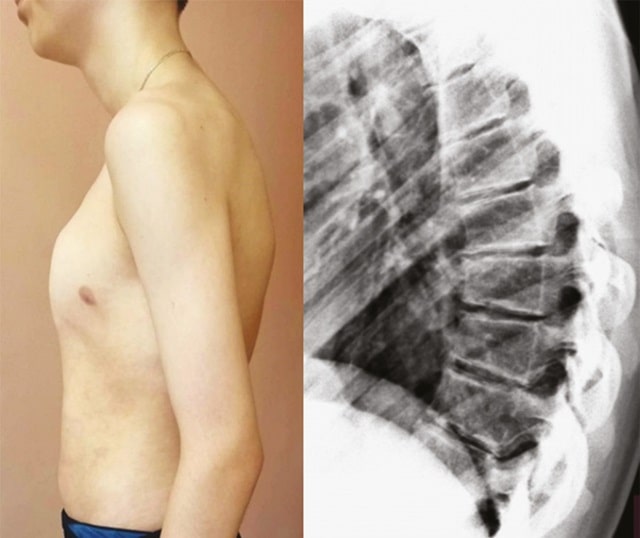 Юнацький кіфоз Шейермана: що це таке, чому виникає, чим небезпечний - фото2