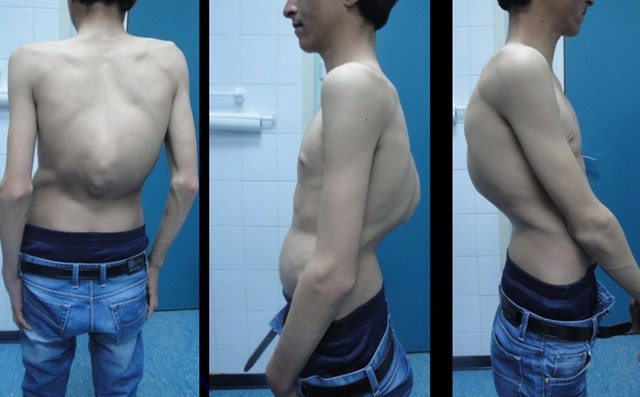 Юнацький кіфоз Шейермана: що це таке, чому виникає, чим небезпечний - фото3