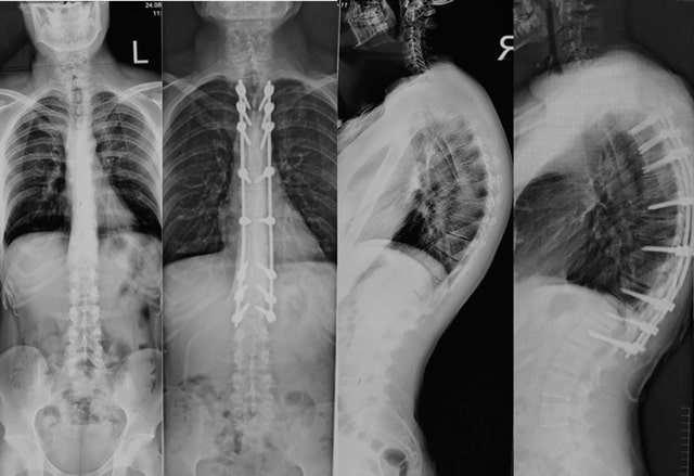 Юнацький кіфоз Шейермана: що це таке, чому виникає, чим небезпечний - фото4