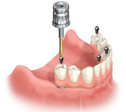 Виды протезирования зубов: какой протез лучше - фото4