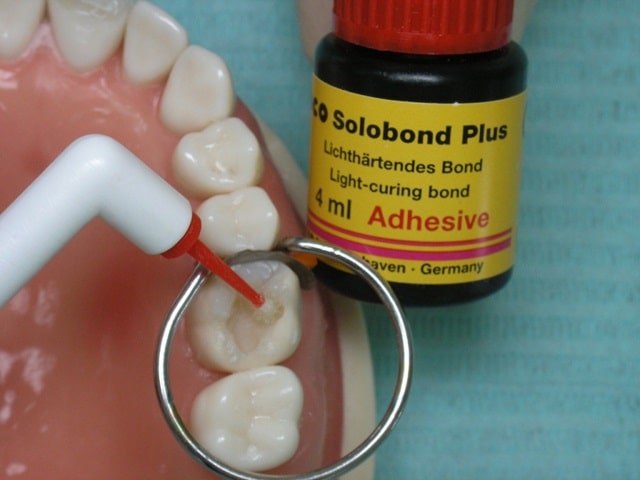 Адгезивні системи в стоматології: що це таке, види, застосування - фото2